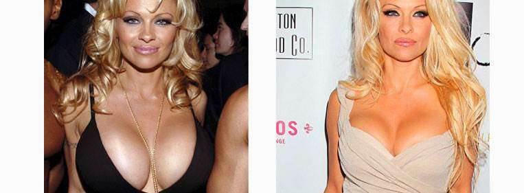 Antes e depois da Pamela Anderson silicone 400ml
