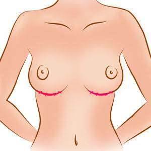 Silicone pela aréola, pela axila ou abaixo da mama: qual é a melhor?