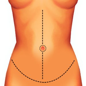 Abdominoplastia em âncora: como se livrar daquela barriga avental tão indesejável