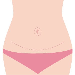 Abdominoplastia: Cicatriz Bonita é Possível Sim! Siga as Principais Dicas dos Especialistas