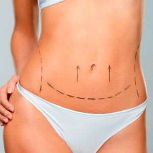 Abdominoplastia recuperação, chega de dúvidas! Especialistas reúnem o que você precisa saber para ter sucesso neste período