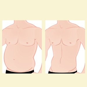 Lipoaspiração Masculina: descubra por que os homens estão quebrando o tabu e recorrendo às cirurgias plásticas