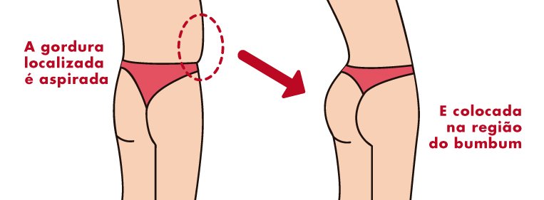 Vale a pena tirar gordura da barriga e colocar no glúteo? tirar gordura da barriga e colocar no gluteo