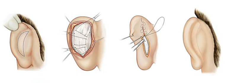Ilustração de como é feita otoplastia, com quatro orelhas em seus diferentes estágios ao longo da cirurgia (fechada com marcações, aberta, sendo suturada e após o procedimento)
