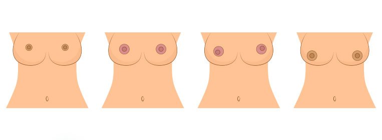 Mastopexia para corrigir os pequenos detalhes auréola da mama