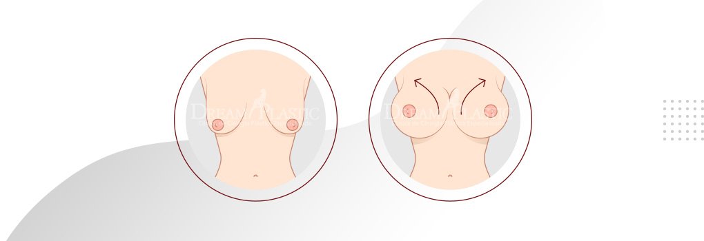 Mastopexia com silicone: o antes e depois é surpreendente Duas imagens de seios, a primeira com mamas caídas e flácidas e a outra alta, redonda e bem marcada, após a mastopexia com silicone