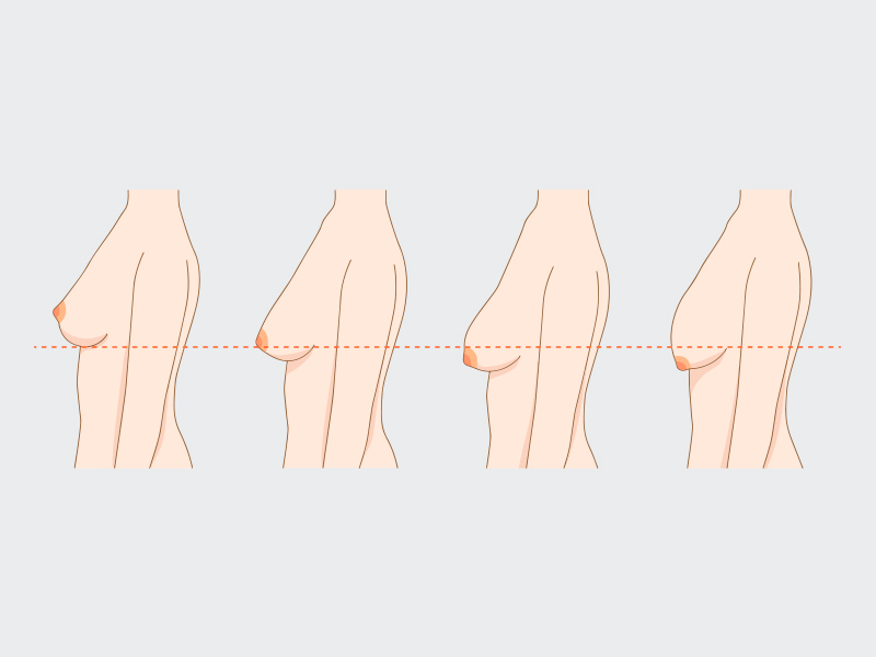 Ilustração mostrando os graus de queda dos seios até a pseudoptose da mama