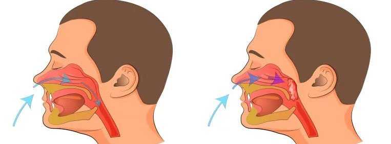 adenoide no nariz