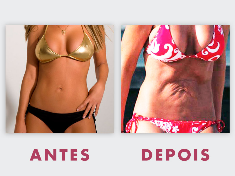 Antes e depois de abdominoplastias que deram errado