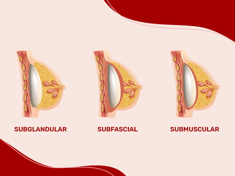 ilustração com as diferentes formas de colocar silicone