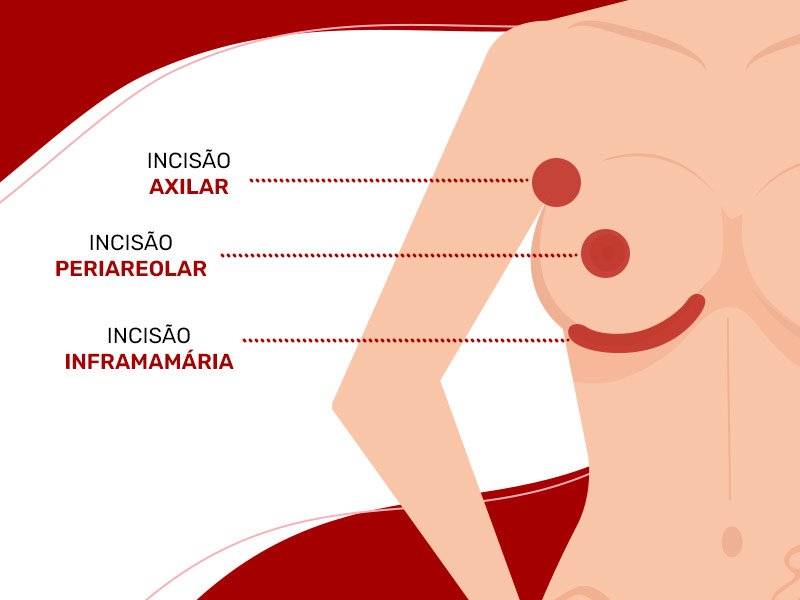 ilustração mostrando as diferentes regiões de inserção