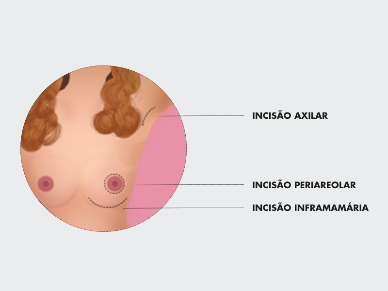 ilustração de incisão de implante silicone pela aréola, axila ou abaixo da mama