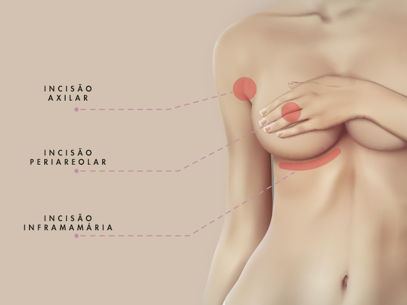 ilustração com a cicatriz do silicone nos seios
