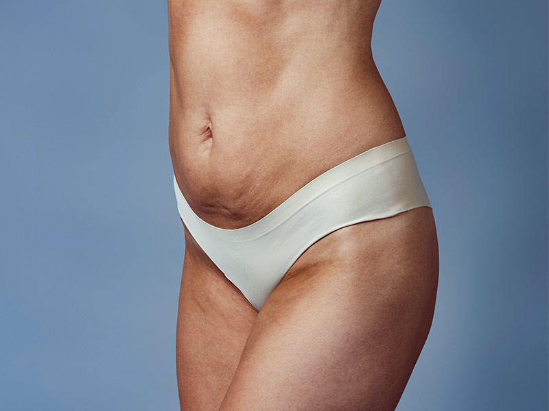 O que é fibrose? Barriga de mulher com fibrose