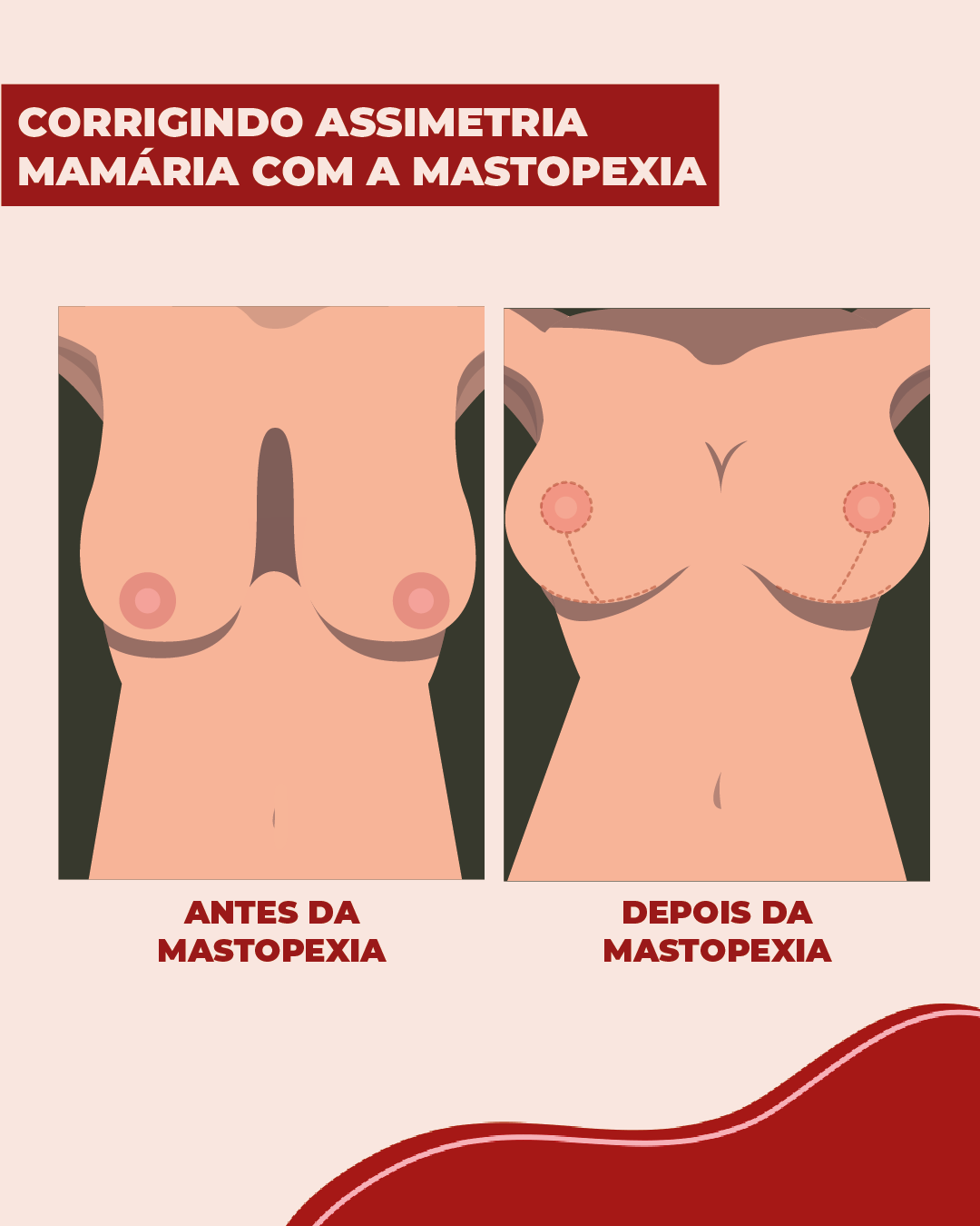 Como corrigir a assimetria mamária? Como corrigir a assimetria mamária com mastopexia