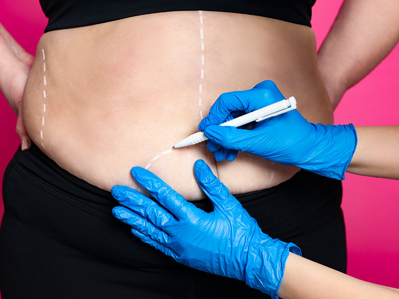 Como é a fibrose na lipoaspiração? Mãos com luvas azuis fazendo as marcações para a lipoaspiração em barriga de mulher, tomando os cuidados certos para evitar a fibrose
