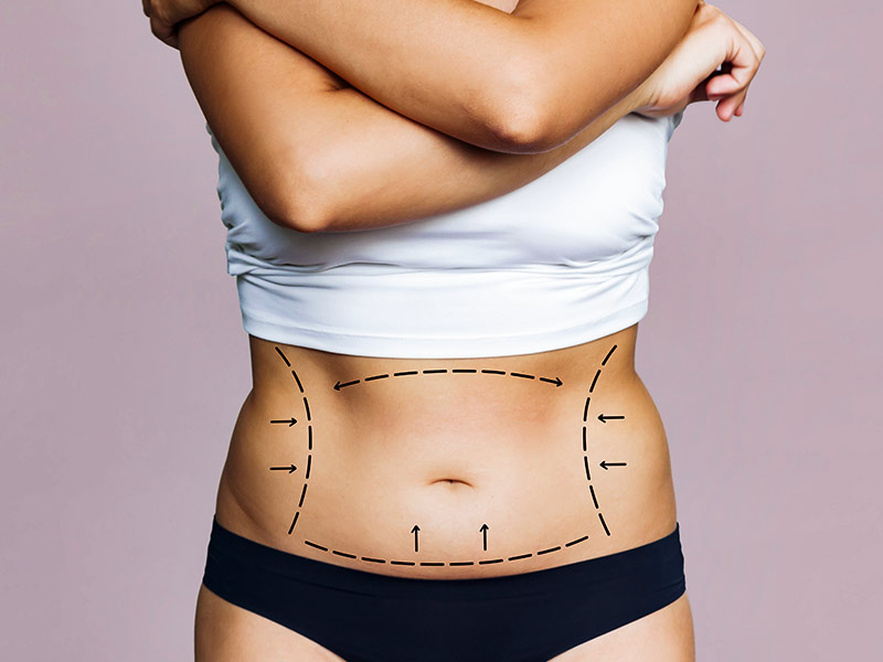 Mulher de cropped branco, com as marcações para a cirurgia de abdominoplastia