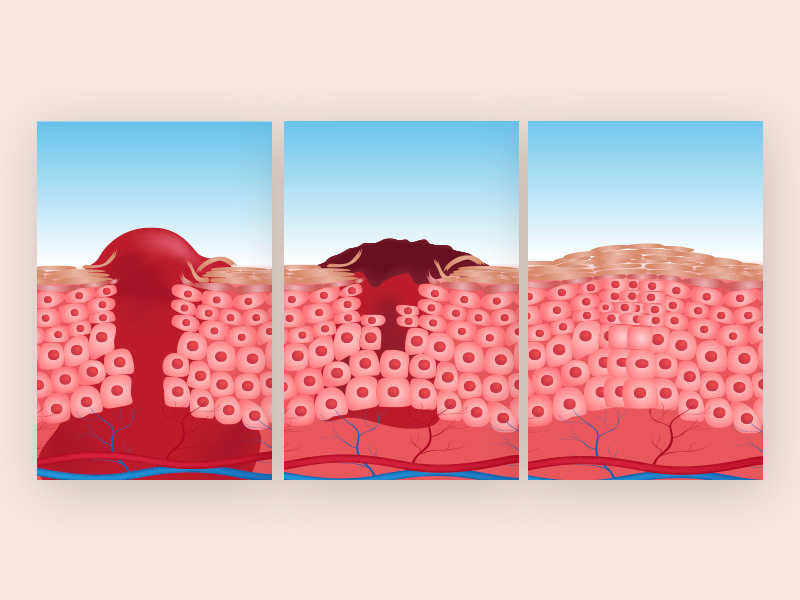 Ilustração que mostra o que causa fibrose, o colágeno formando um nódulo