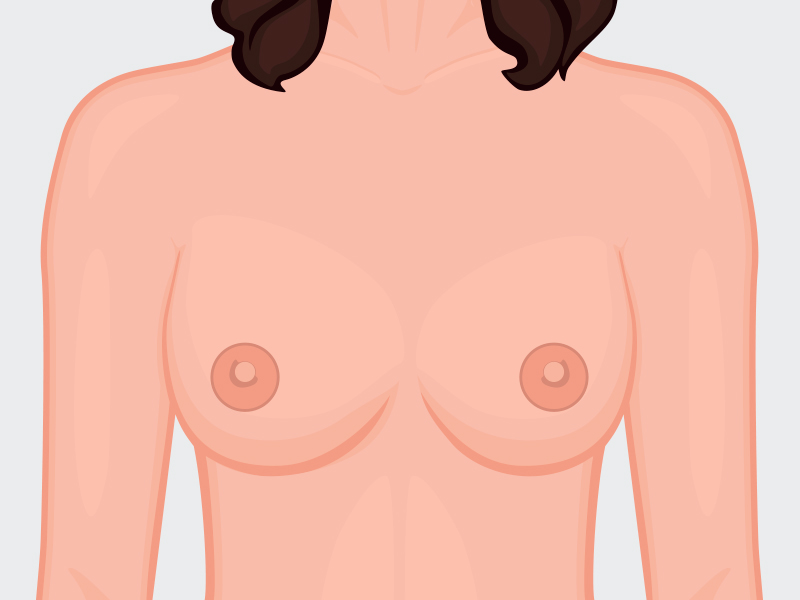 ilustração com mamas assimetricas de tamanhos diferentes