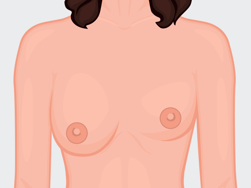 O que é assimetria mamária? seios assimetricos