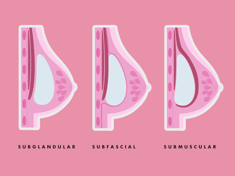 ilustração com a localização das próteses, sendo subglandular, subfascial e submuscular