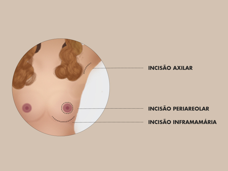 Mamoplastia de aumento via axilar, areolar ou inframamária? mamoplastia aumento axilar areolar cicatriz