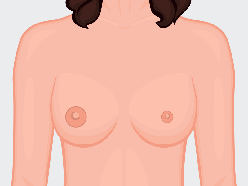 ilustração com mamas assimétricas de auréolas diferentes