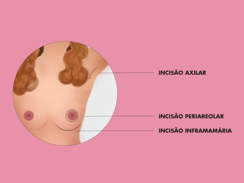 Ilustração mostrando as diferentes formas de incisão para mamoplastia de aumento