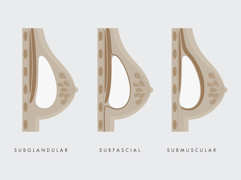 Mamoplastia de aumento subfascial, submuscular ou subglandular? mamoplastia aumento subsfacial