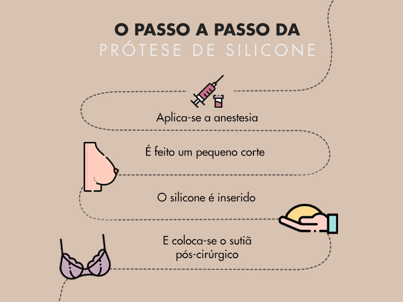 ilustração com o passo a passo da mamoplastia de aumento