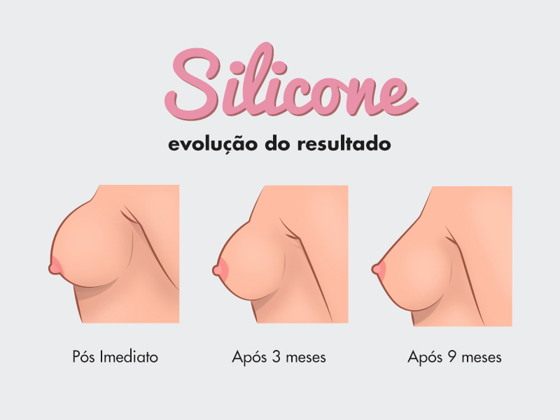 Silicone 2, 3 meses depois… O resultado da prótese de mama, leva algum tempo...