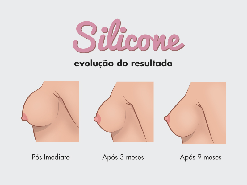 Silicone 2, 3 meses depois… silicone 2 meses depois