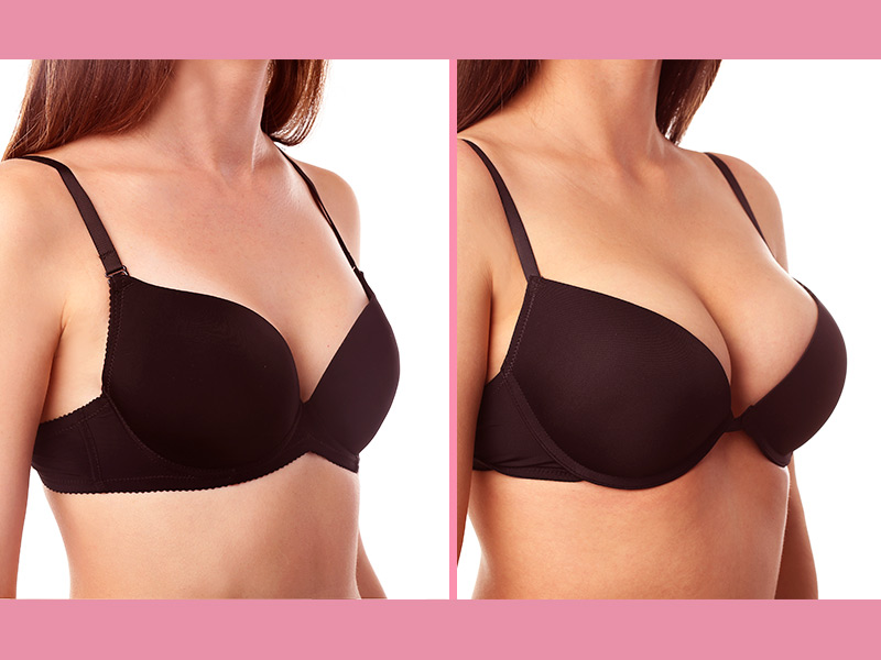 Peitos com silicone: antes e depois silicone antes depois