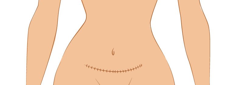 Como melhorar a cicatriz da abdominoplastia? cicatriz abdominoplastia