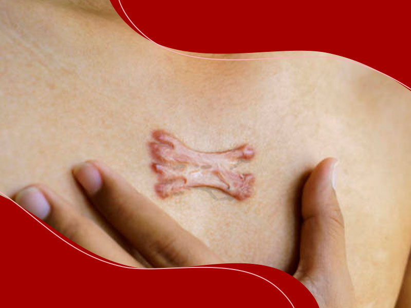 Mãe esquerda mostrando uma queloide na tatuagem