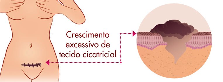 O que é queloide? queloide tratamento