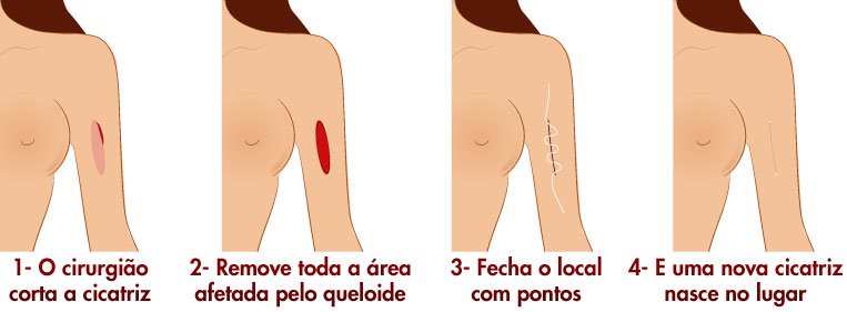 Passo a passo da cirurgia plástica para corrigir cicatriz cirurgia plástica de cicatriz