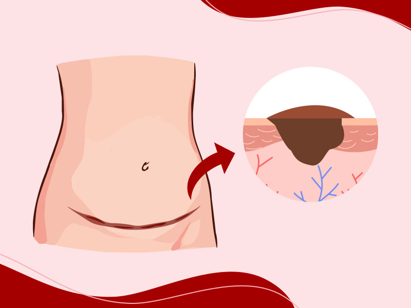 Ilustração que mostra um dos principais sintomas de queloide, o crescimento da cicatriz para além da ferida