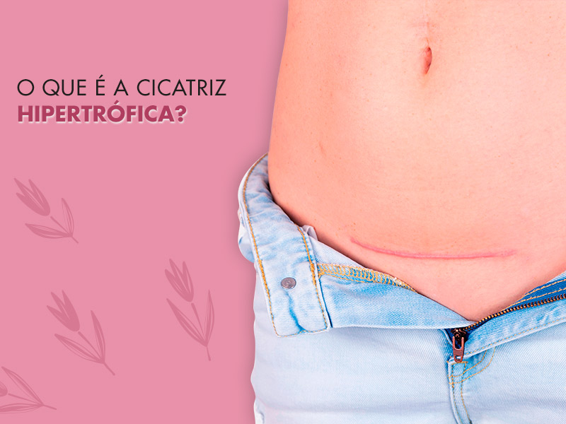 Cicatriz hipertrófica tem tratamento? Descubra o que é e como eliminar! cicatriz hipertrofica