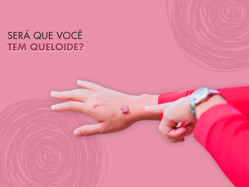 Queloide: o que é, como tirar e quais os principais tratamentos para as cicatrizes queloidianas queloide