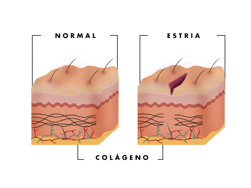 ilustração mostrando o que são estrias e como fica a pele com as marcas