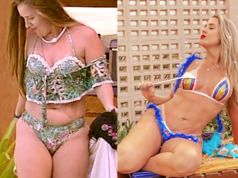 Fotos da miniabdominoplastia da Patrícia Leitte mini abdominoplastia fotos