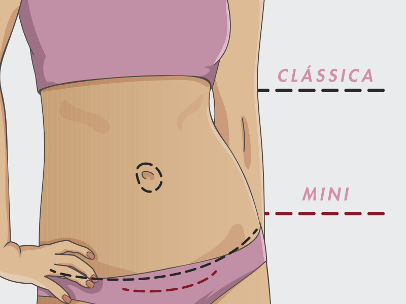 ilustração com a diferença da miniabdominoplastia para a abdominoplastia clássica