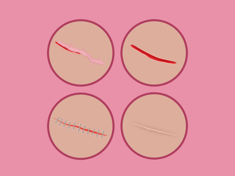 Como é a cirurgia para cicatriz hipertrófica? tratamento cicatriz hipertrofica