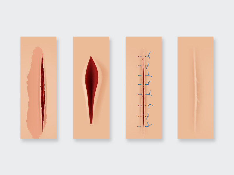 Ilustração que mostra o passo a passo do melhor tratamento para queloide, a cirurgia. Desde o corte ao redor da cicatriz até os pontos e a sua cicatrização correta