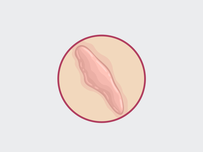 Como se forma o queloide? Ilustração que mostra como é a queloide na cicatriz