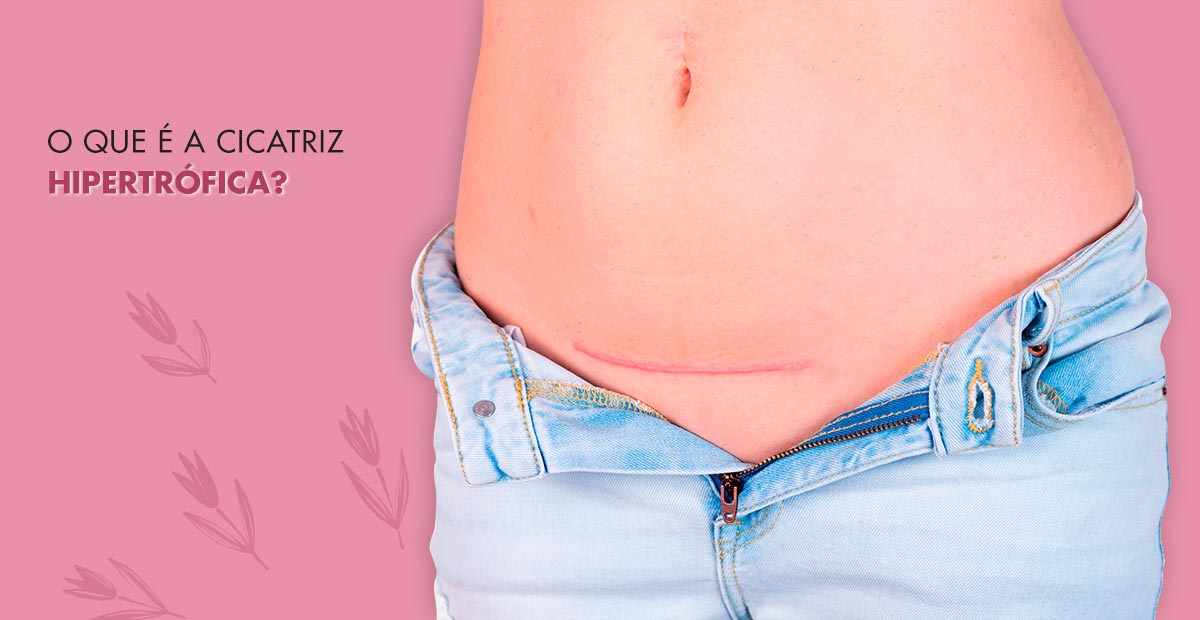 Cicatriz Hipertrófica: O que é, como tratar e diferenças do queloide