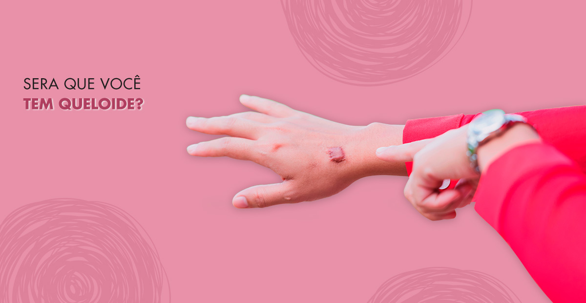 Queloide O guia completo está aqui! Dream Plastic