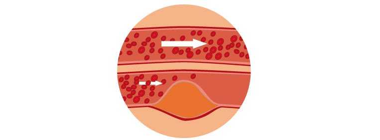 Ilustração que mostra o sangue coagulando no interior de veia e causando a trombose venosa profunda
