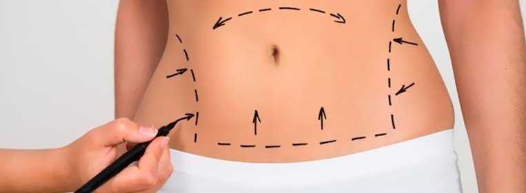 Como é feita a cirurgia plástica de dermolipectomia? cirurgia plastica dermolipectomia